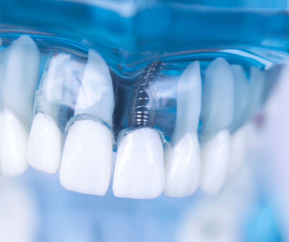 Implant dentar Stoma Urgent