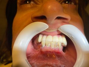 implant dentar StomaUrgent