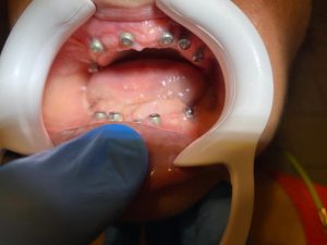 implant dentar StomaUrgent