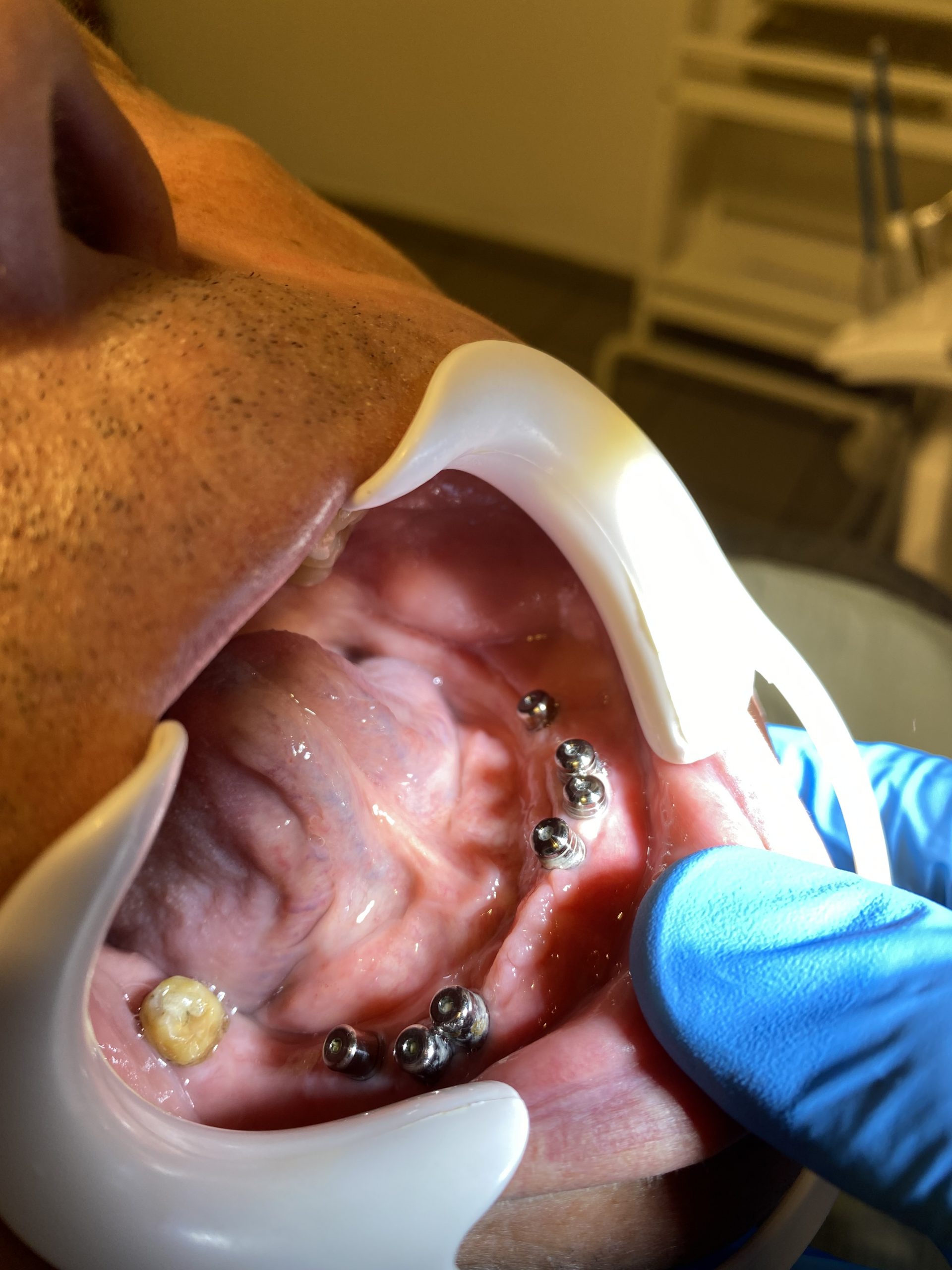 Clinica stomatologica StomaUrgent - implant dentar