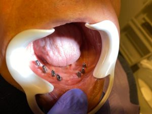 Implant dentar StomaUrgent Bucuresti_2