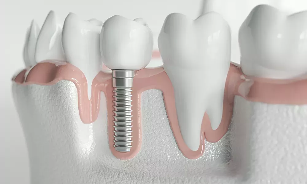 cat-costa-un-implant-dentar