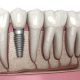 implant-dentar-pret