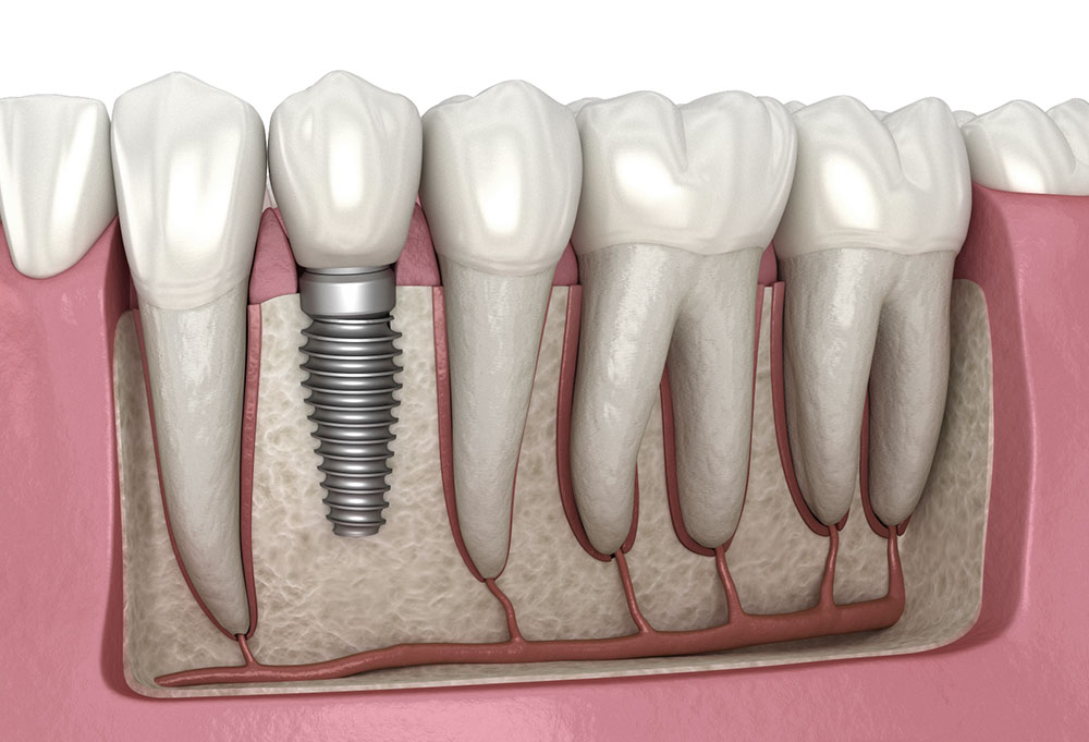 implant-dentar-pret
