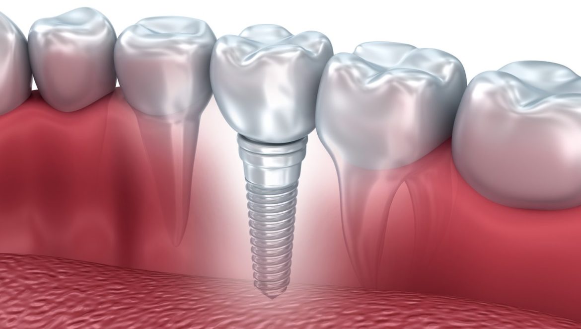 implanturi-dentare-pret