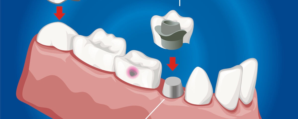 coroane dentare pe implanturi