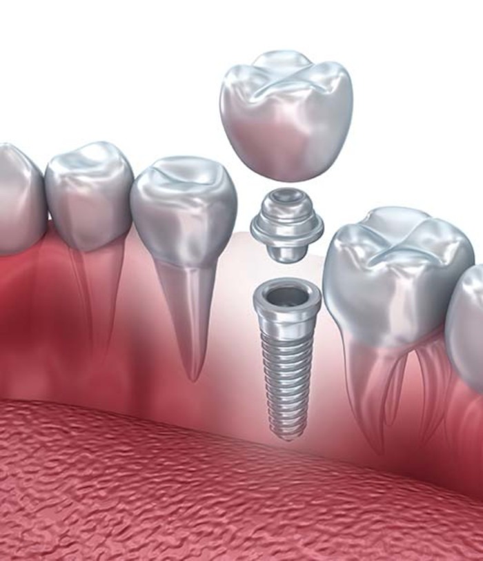 implant-dentar-metalic