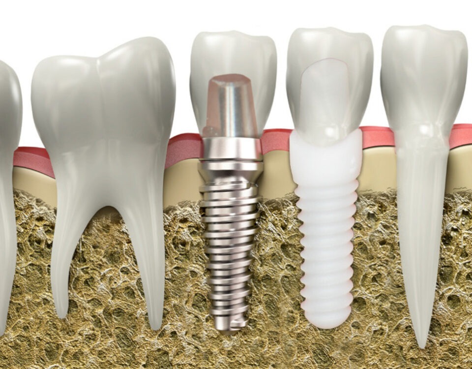implant-dentarzirconiu