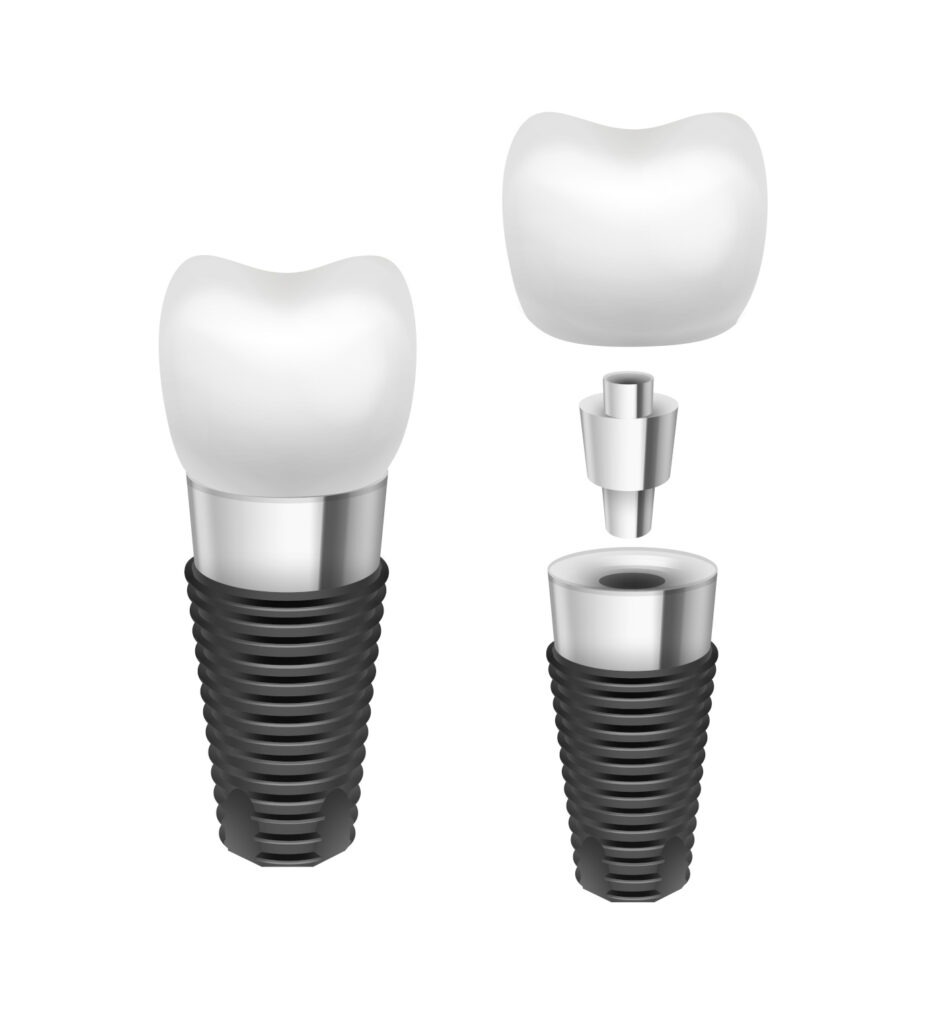 Cum-alegi-cel-mai-bun-implant-dentar
