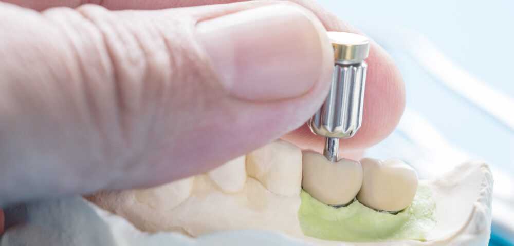 implant-dentar-acoperit-decoperit