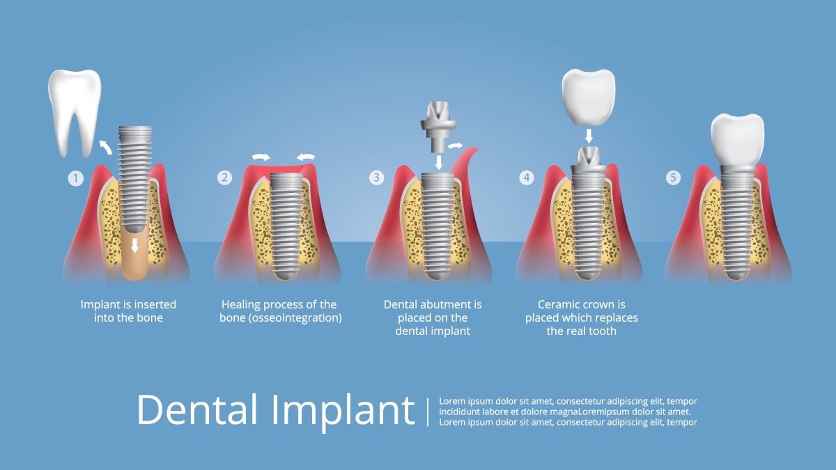 Avantajele-sistemului-de-implant-dentar-All-on-4