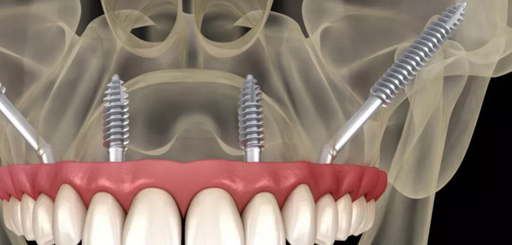 Implanturi-Dentare-Zigomatice