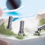 implanturi-dentare-all-on-4
