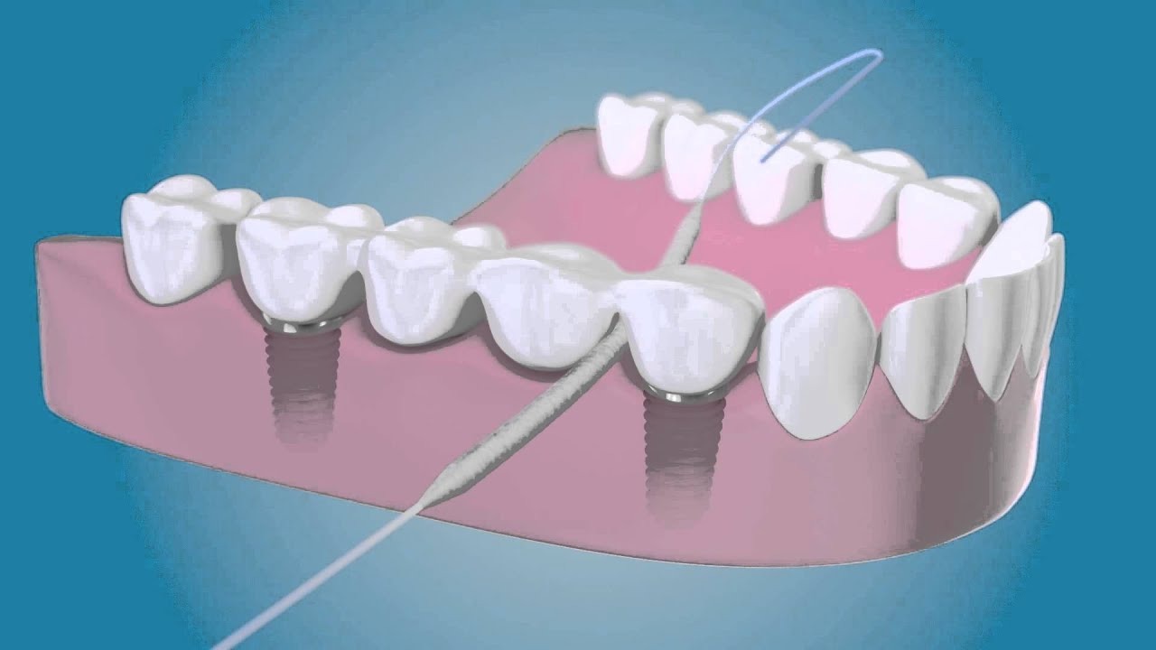sutura-dupa-implant-dentar